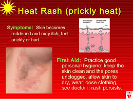 How to prevent Heat Rash - MTM